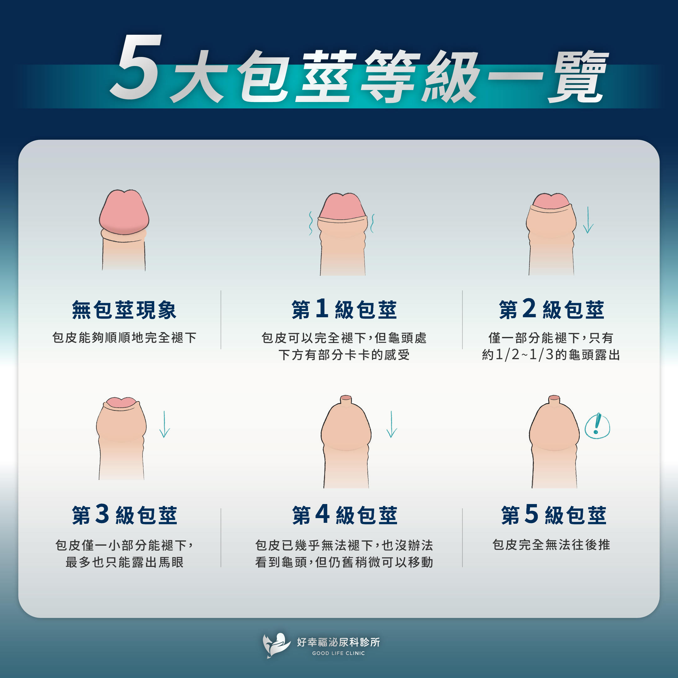 五大包莖等級