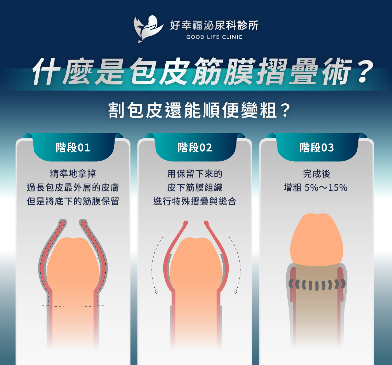 什麼是包皮筋膜折疊術