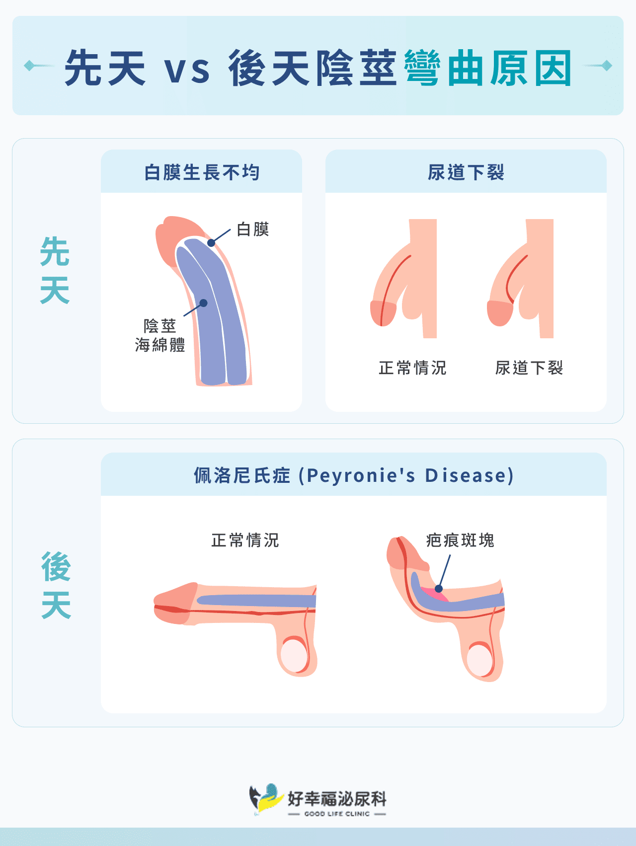 先天 vs 後天陰莖彎曲原因