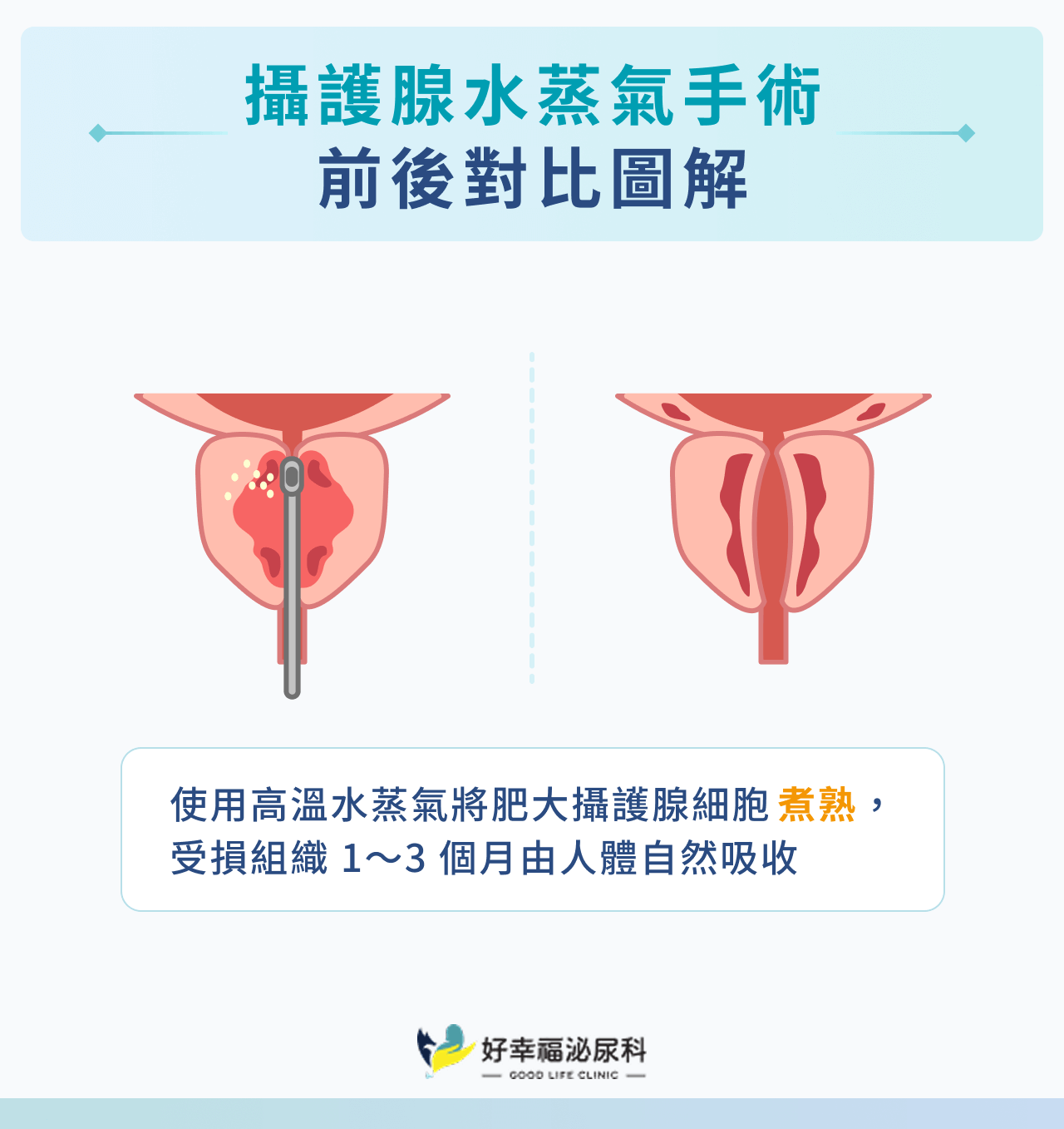 攝護腺水蒸氣手術｜前後對比圖解