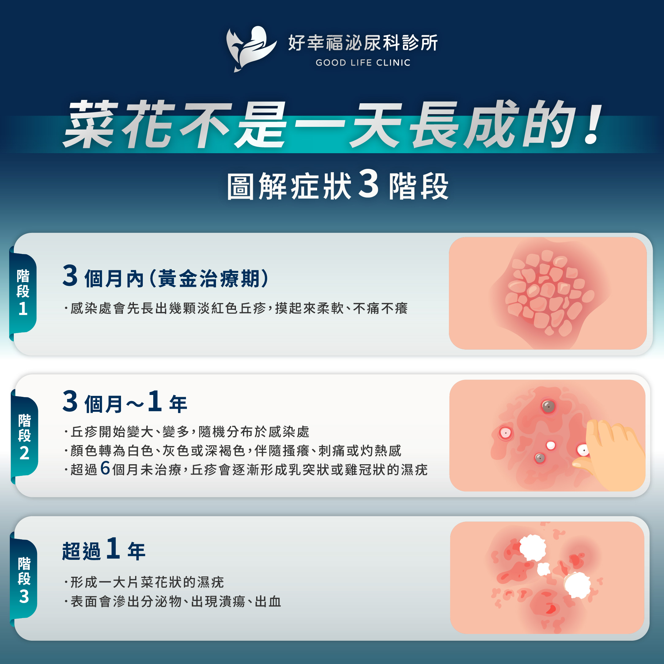 three stages of genital warts's symptoms
