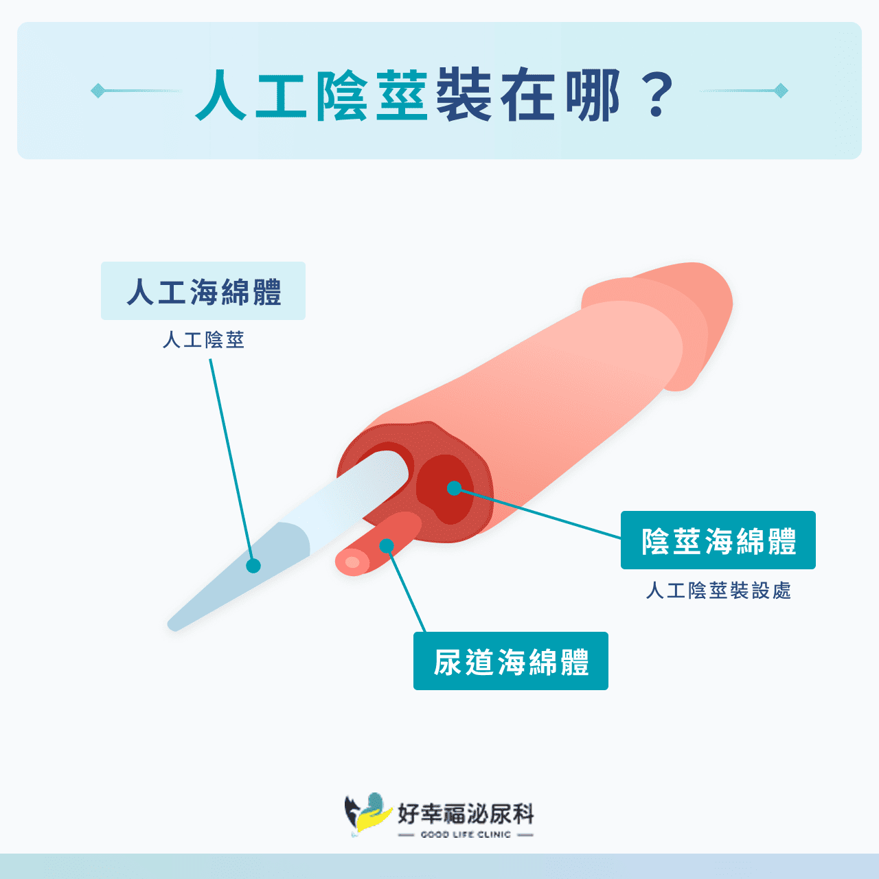 人工陰莖裝在哪？