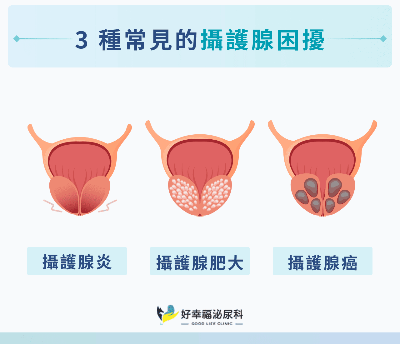 3 種常見的攝護腺困擾