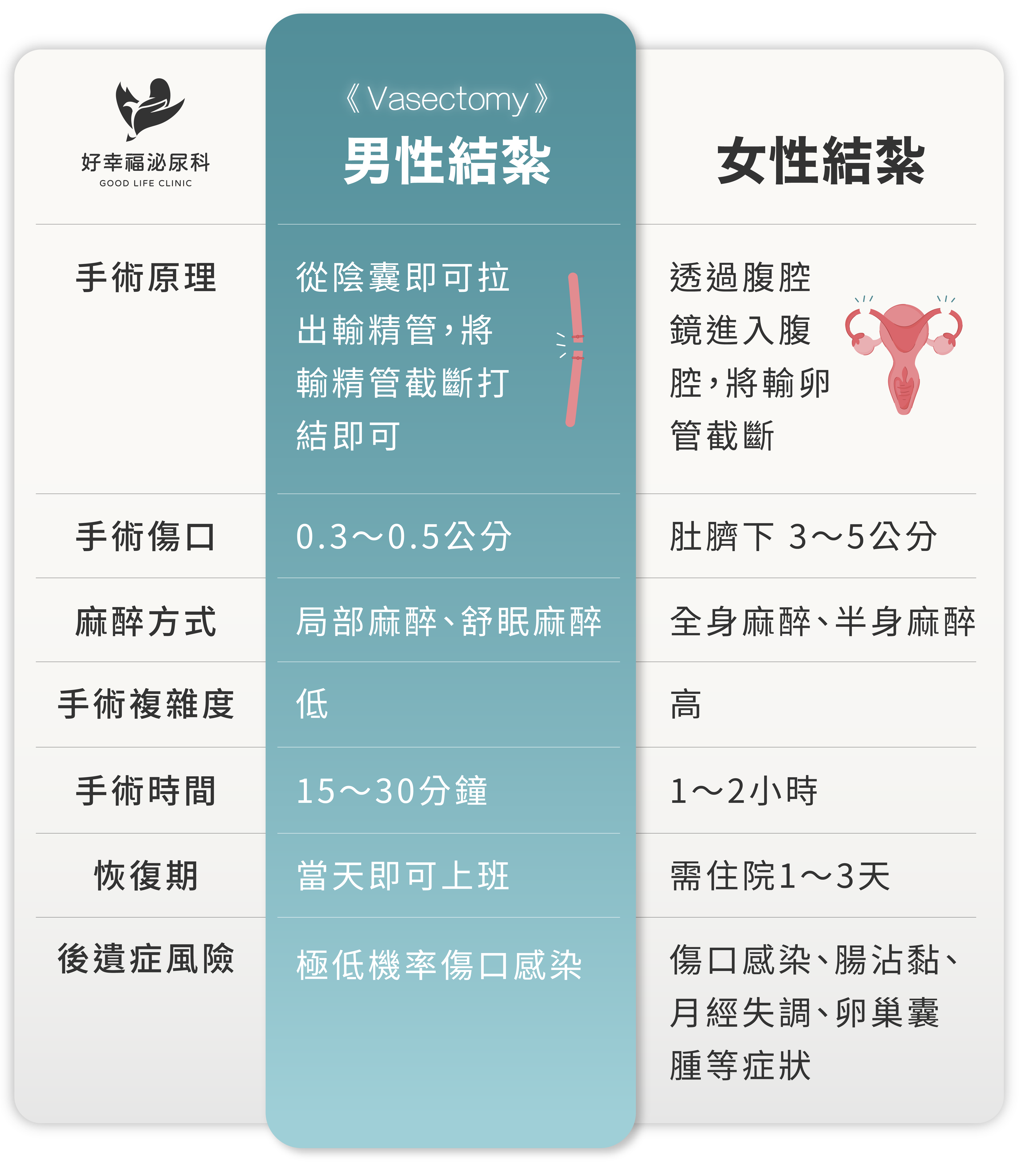 新版結紮：男女結紮比較