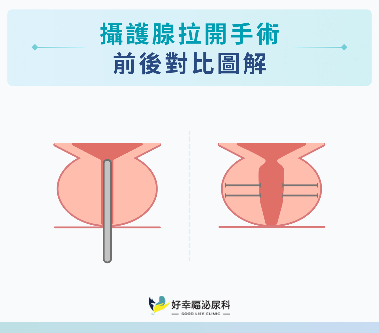 攝護腺拉開手術｜前後對比圖解