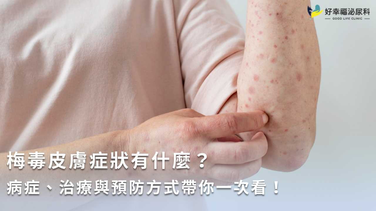 梅毒皮膚症狀有什麼？病症、治療與預防方式帶你一次看！
